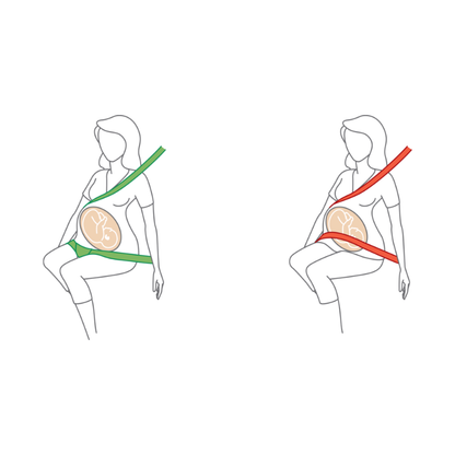 Illustration einer schwangeren Person: links zeigt ein grüner Gurt die korrekte Sitzposition mit Beckengurt unter dem Bauch, rechts zeigt ein roter Gurt die falsche Position über dem Bauch.